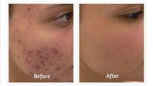 Revitol Acnezine Before and After