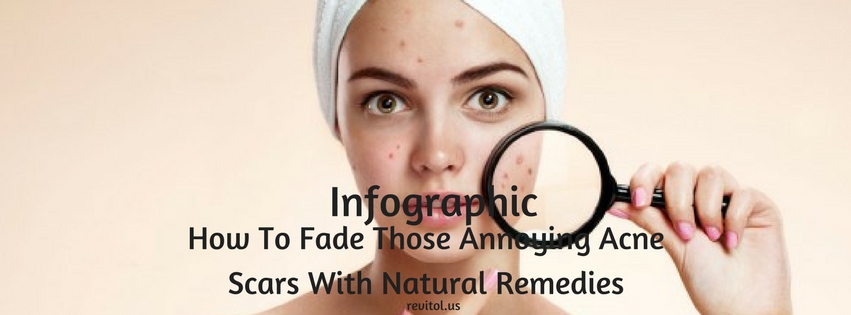 fade acne scars