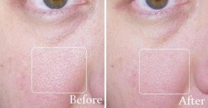 Revitol's Pore Minimizer Before and After