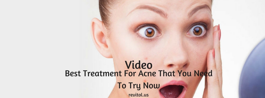 Best Treatment For Acne That You Need To Try Now- Video