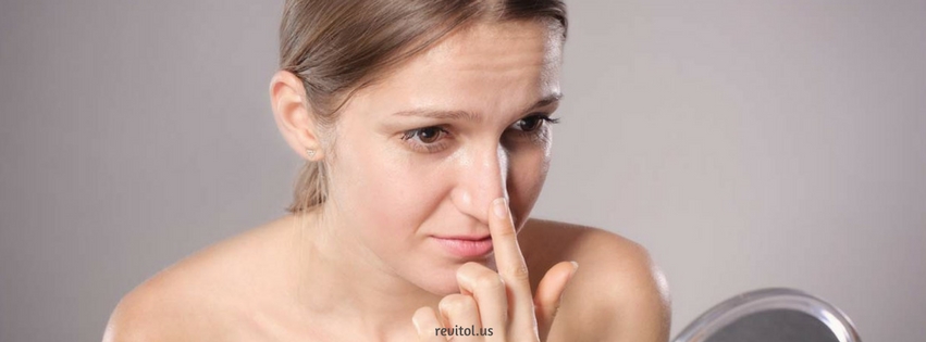 Treatment for Blackheads