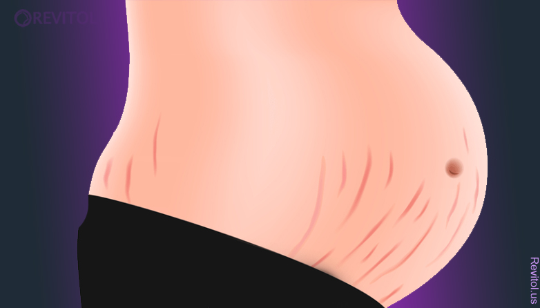 Tips To Get Rid Of Stretch Marks