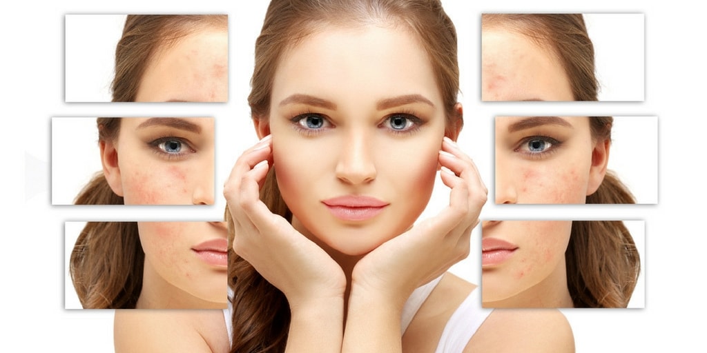 Rosacea-Symptoms