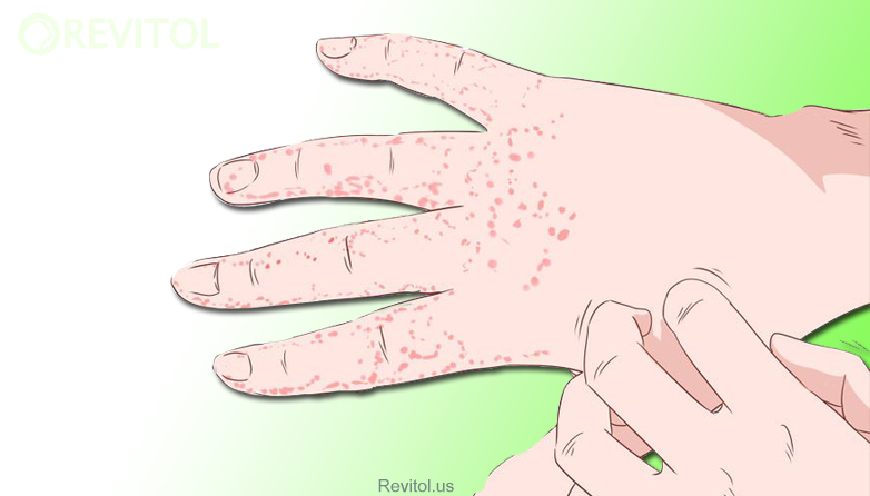 Home Remedies For Scabies