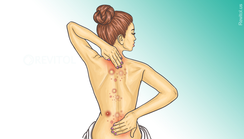 Get Rid Of Back Acne fast