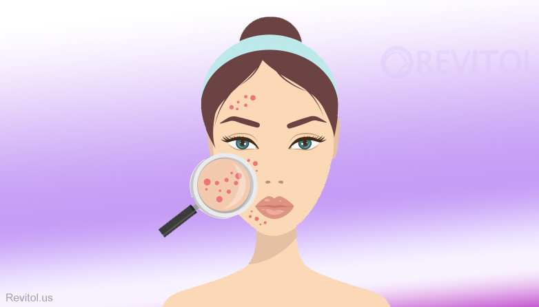 Tips to treat cystic acne naturally