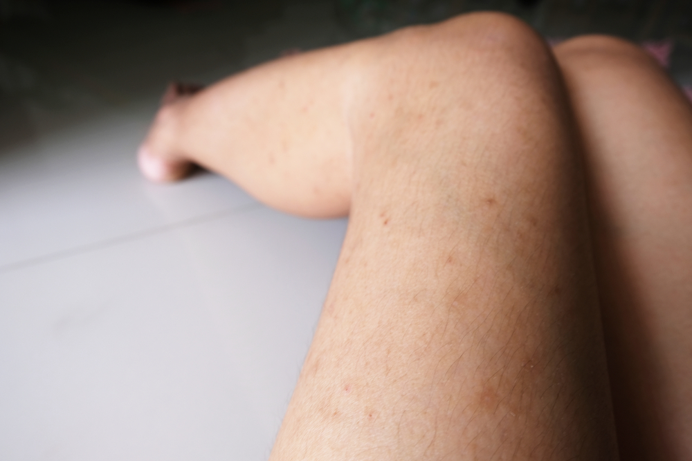 age-spots-on-legs